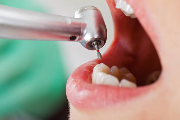 Best Emergency Wisdom Teeth Removal in Wilmore, KY